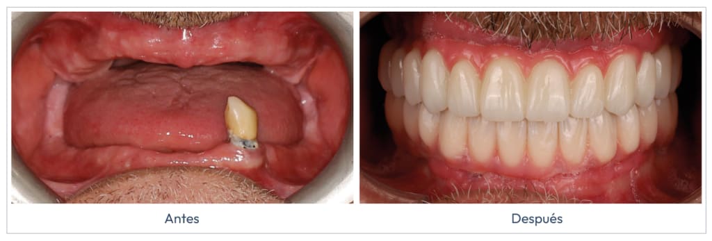 implantes-subperiosticos-foto