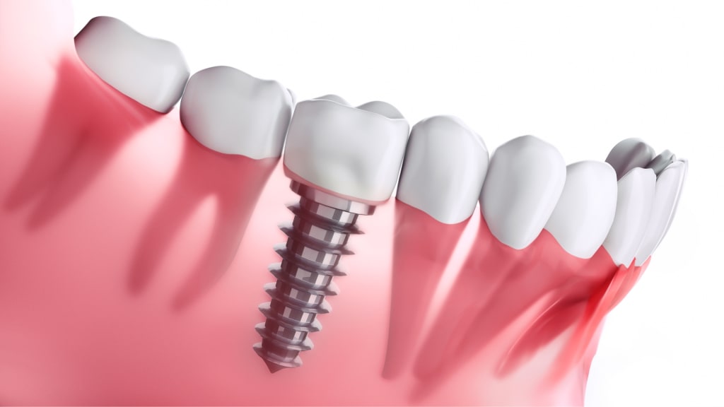 implantes-muelas-madrid