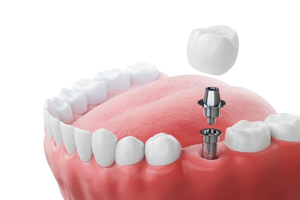 Implantes Carga Inmediata Landing Implantes Dentales.jpg