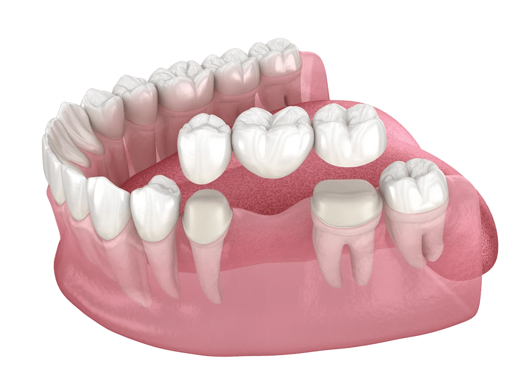 corona-dental-madrid