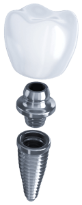 Implante Dental Partes.png