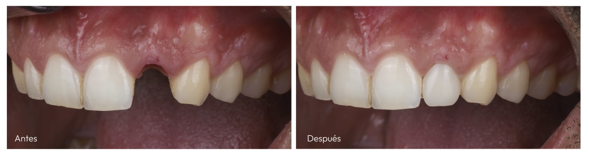 antes-y-despues-implantes-madrid2