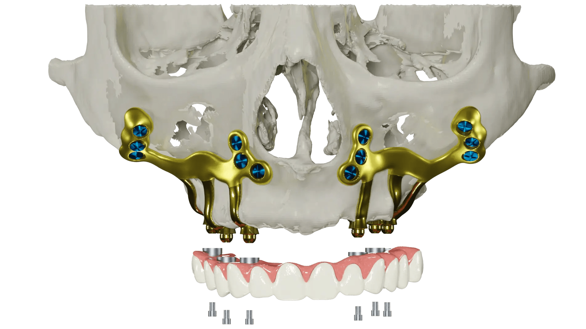 implantes-sin-tornillos