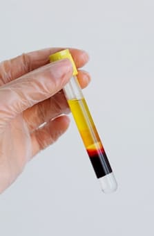 PRGF (plasma rico en factores de crecimiento)