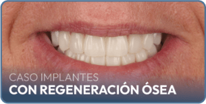caso-implantes-con-regeneracion-osea
