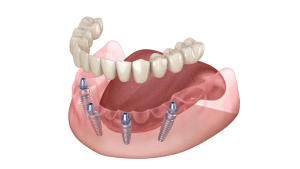 Implantes de carga inmediata the-all-on-four-technique-1200x800_p73zgl