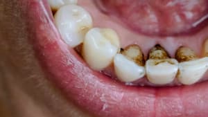 manchas-en-los-dientes-madrid_1_r8psxn