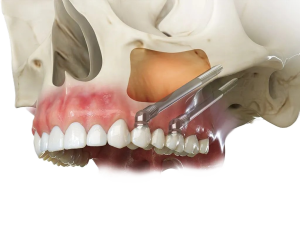 implantes-cigomaticos-madrid-palma