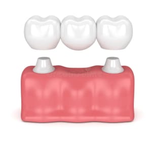 puente-dental-tradicional