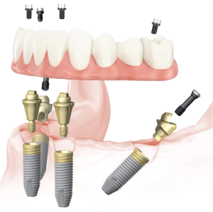 implantes-inclinados_ahmqh6
