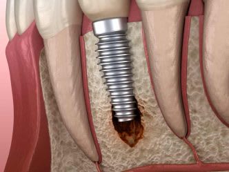 rechazo-tardio-implante-dental_w6hqhm
