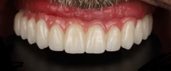 implantes sin tornillos_subperiosticos