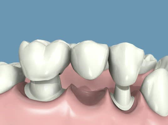 cementado-puente-dental