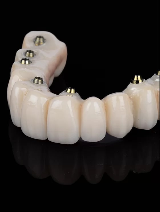 protesis-fija-sobre-implantes_mvvjxv