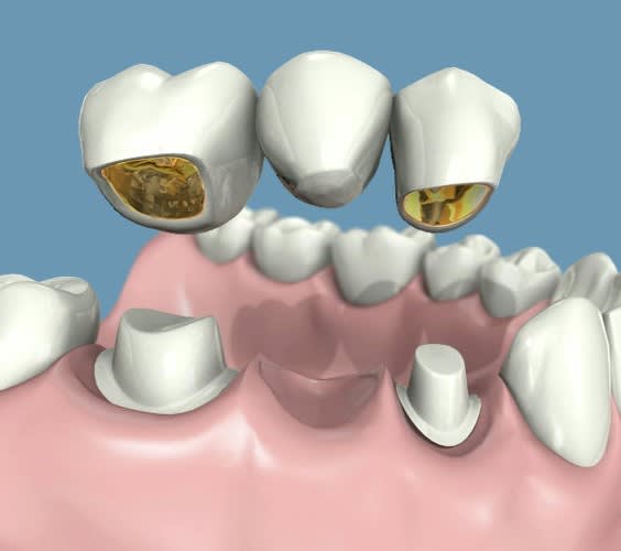 tallado-dental-puente-2