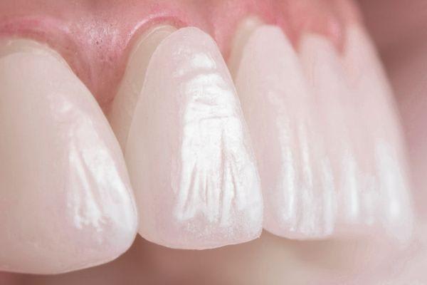microcarillas-dentales-madrid_ce9yo1_pu46yw