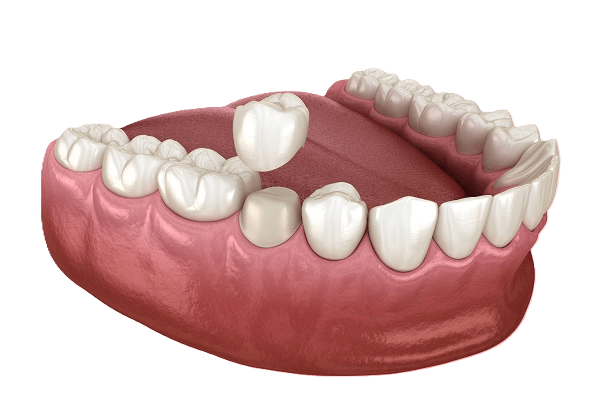 dental-crowns-2205_jtodwl_rlgywb