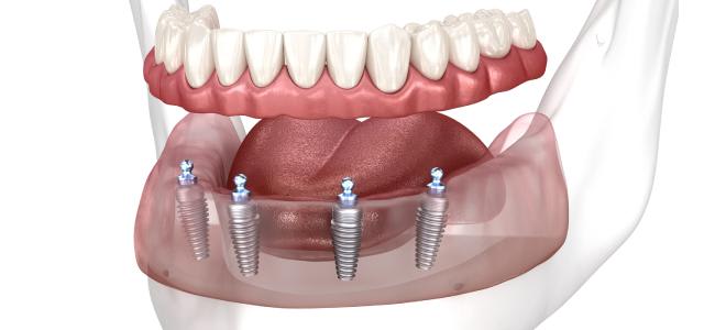 dentadura-hibrida vs sin tornillo