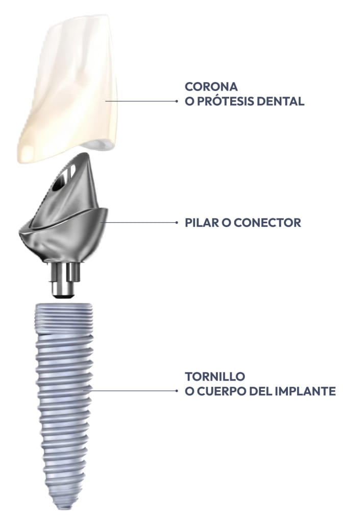 partes_implante_dental_wt1qbp