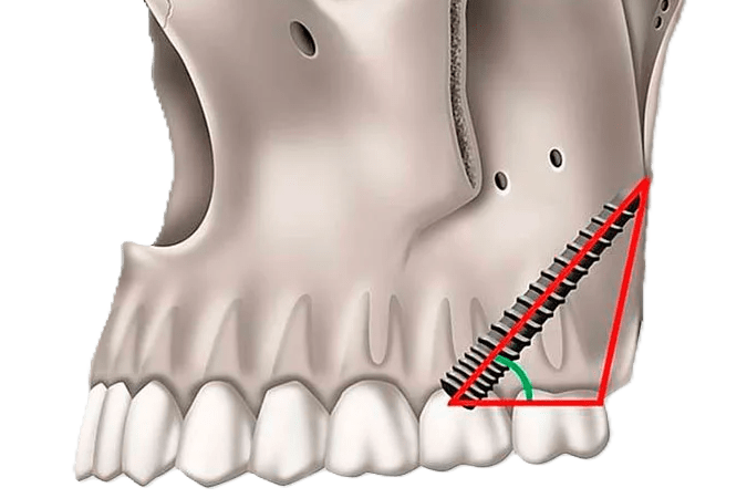 implantes-pterigoideos2_u388yo