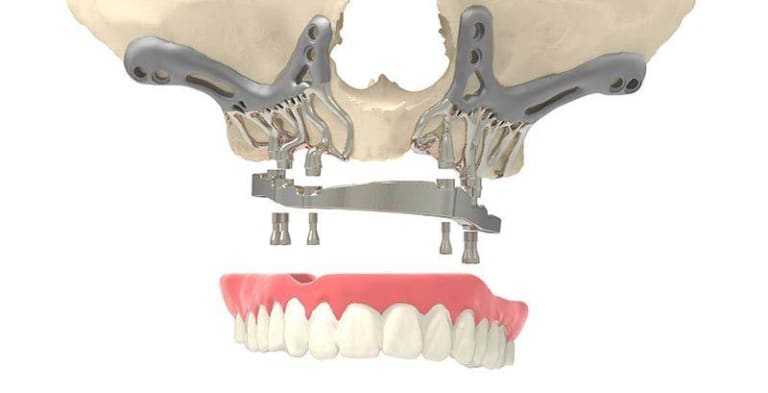 Subperiostalis-implantatum-Idealis-megoldas-csonthiany-eseten-e1691746831728_bzpset_1_ucarv0