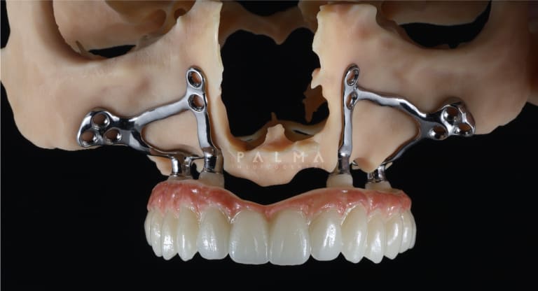 Estructura subperióstica personalizada diseñada mediante TAC 3D