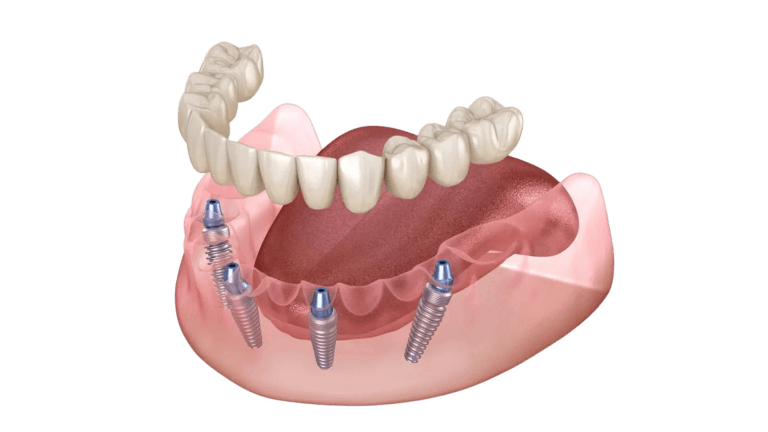 Implantes de carga inmediata the-all-on-four-technique-1200x800_p73zgl