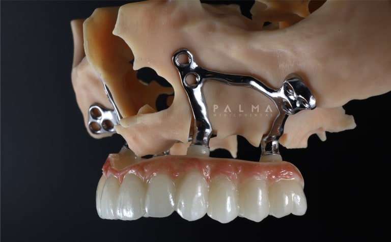 foto-real-implantes-sin-tornillos_j4jeze