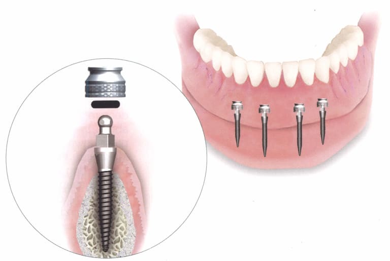 miniimplantes-dentales-madrid