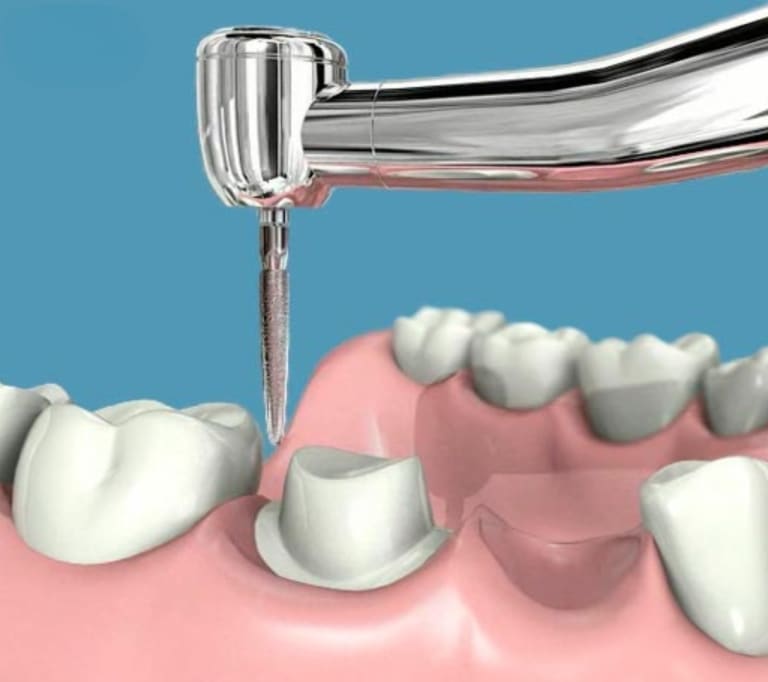 tallado-dental-puente