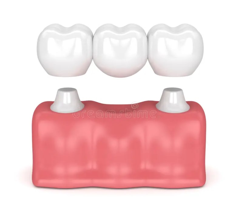 puente-dental-tradicional