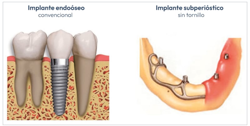 implantes-subperiosticos-vs-convencionales