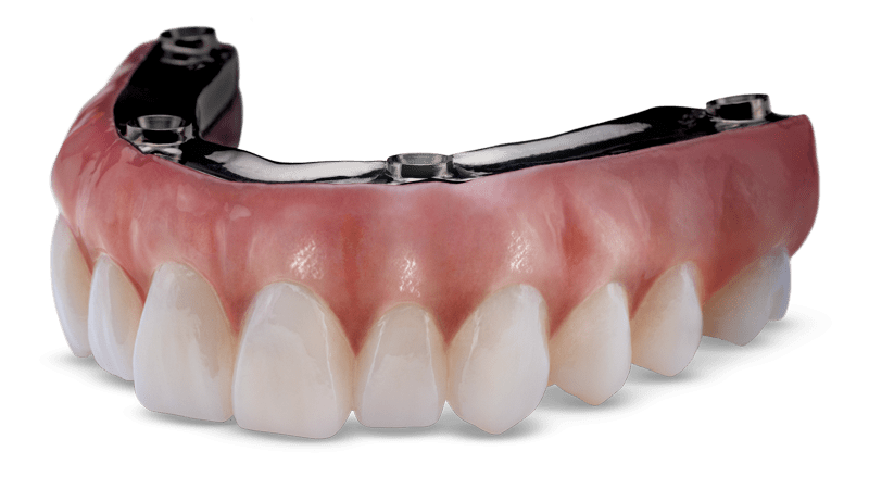 que-es-protesis-dental