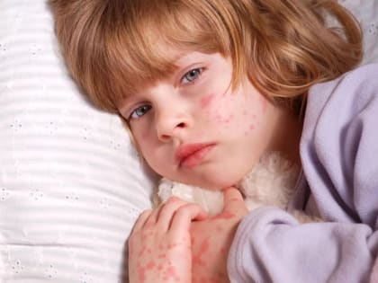 В Волгоградской области еще один человек заболел корью