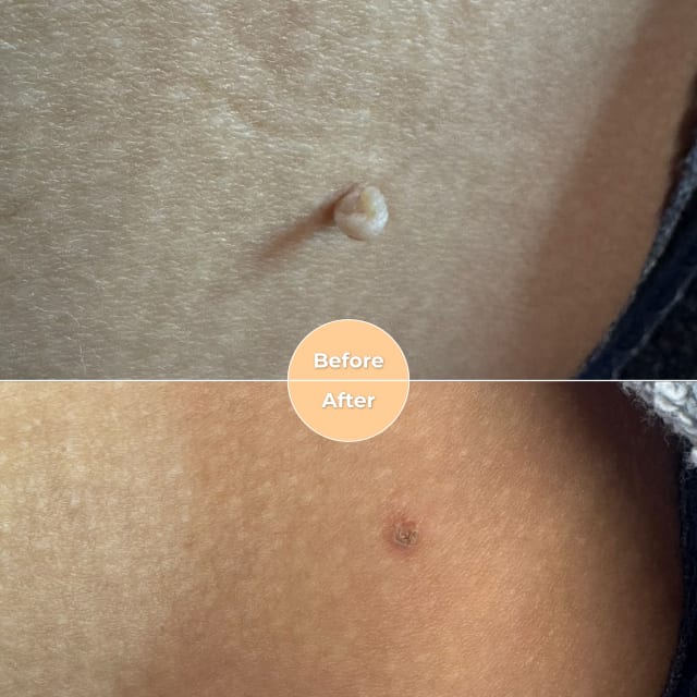 Electrolysis Skin Tag Removal before and after results