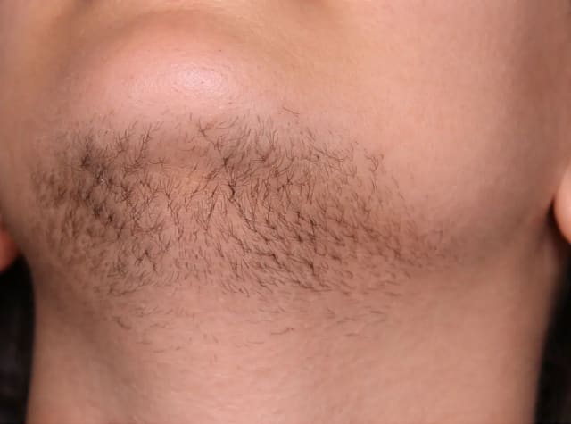 Before electrolysis treatment