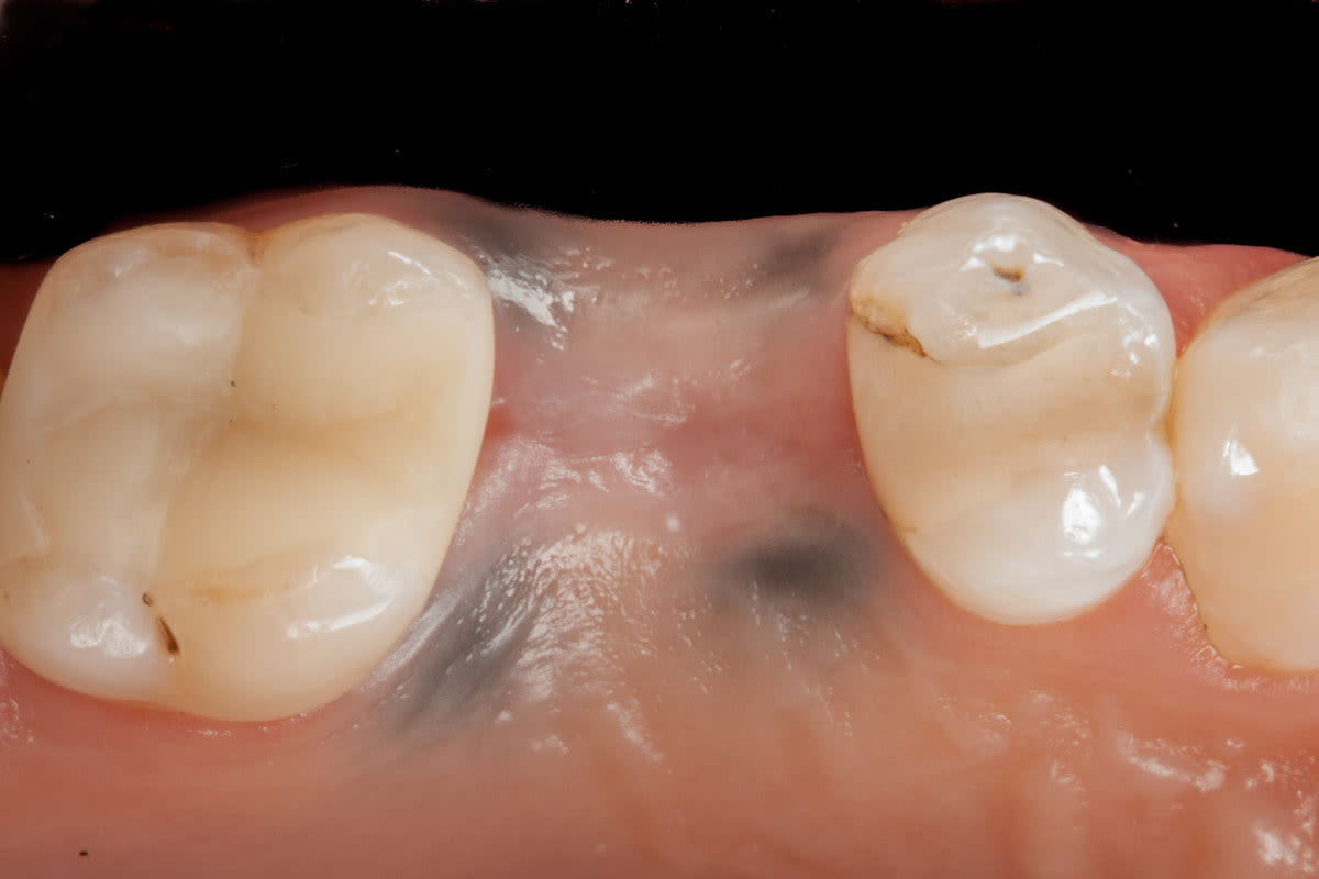 Estetika odstranění tetování z dásní