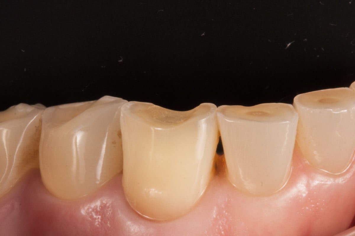 Estetika vnitřní bělení zubů