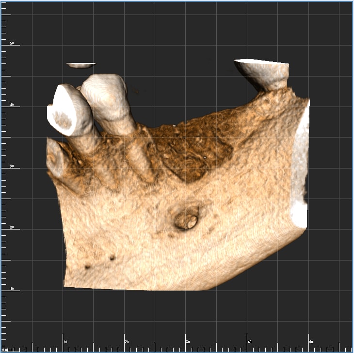 Diagnostika chronický zánět kosti