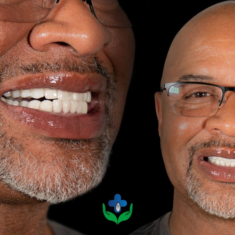 Patient comparing veneer options before treatment at Colombia Care Dental, Medellín