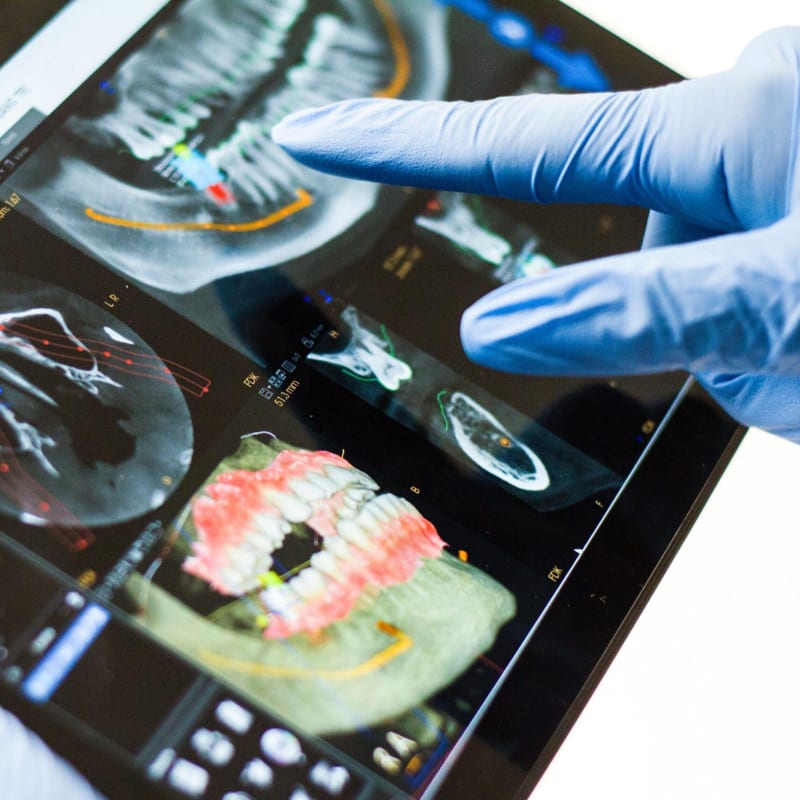 Dentist reviewing a CBCT 3D scan on a tablet to assess bone volume before implant placement, Colombia Care Dental, Medellín