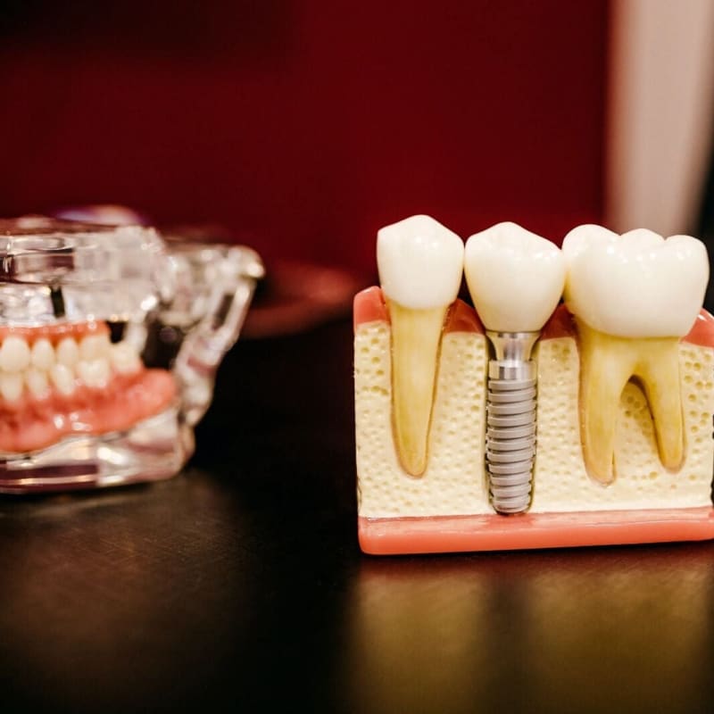 Dental implant model showing BioHorizons titanium post and ZirCAD Prime crown, Colombia Care Dental, Medellín