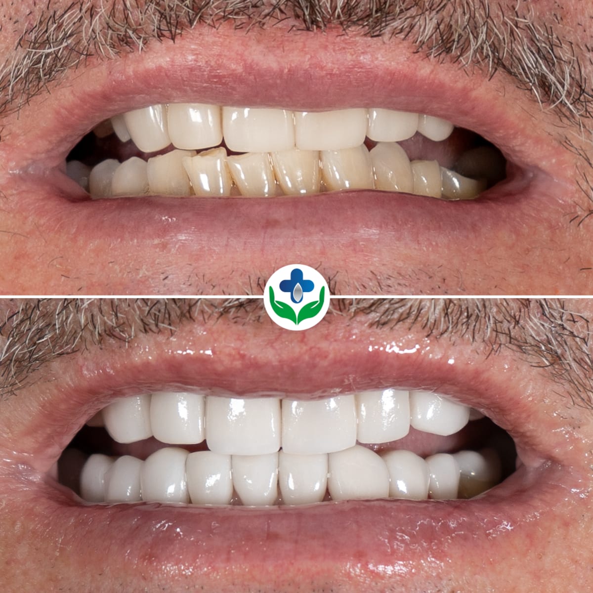 Antes y después de transformación de sonrisa, caso de Douglas, Colombia Care Dental, Medellín
