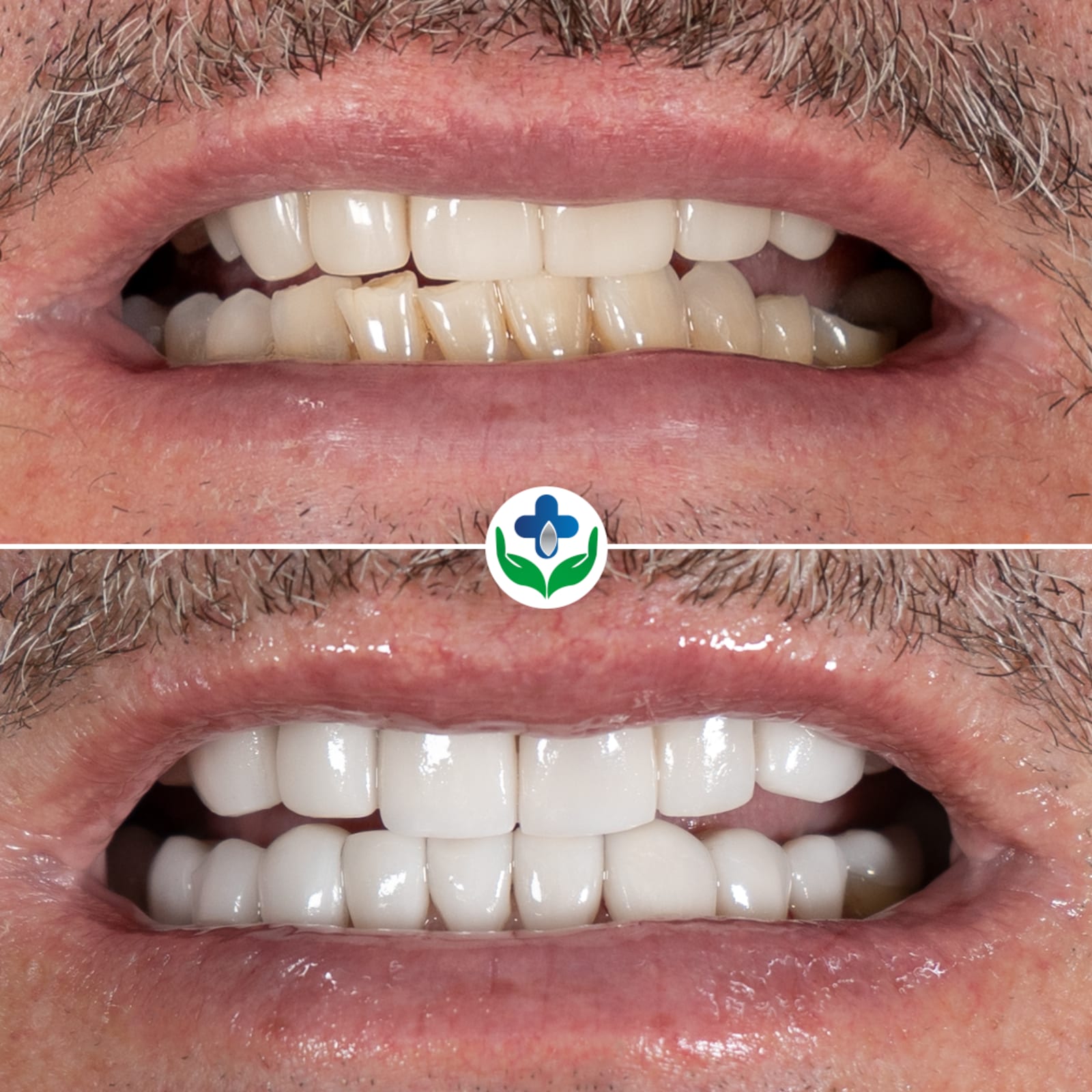 Zirconia and porcelain veneers comparison, full smile redesign, Colombia Care Dental, Medellín