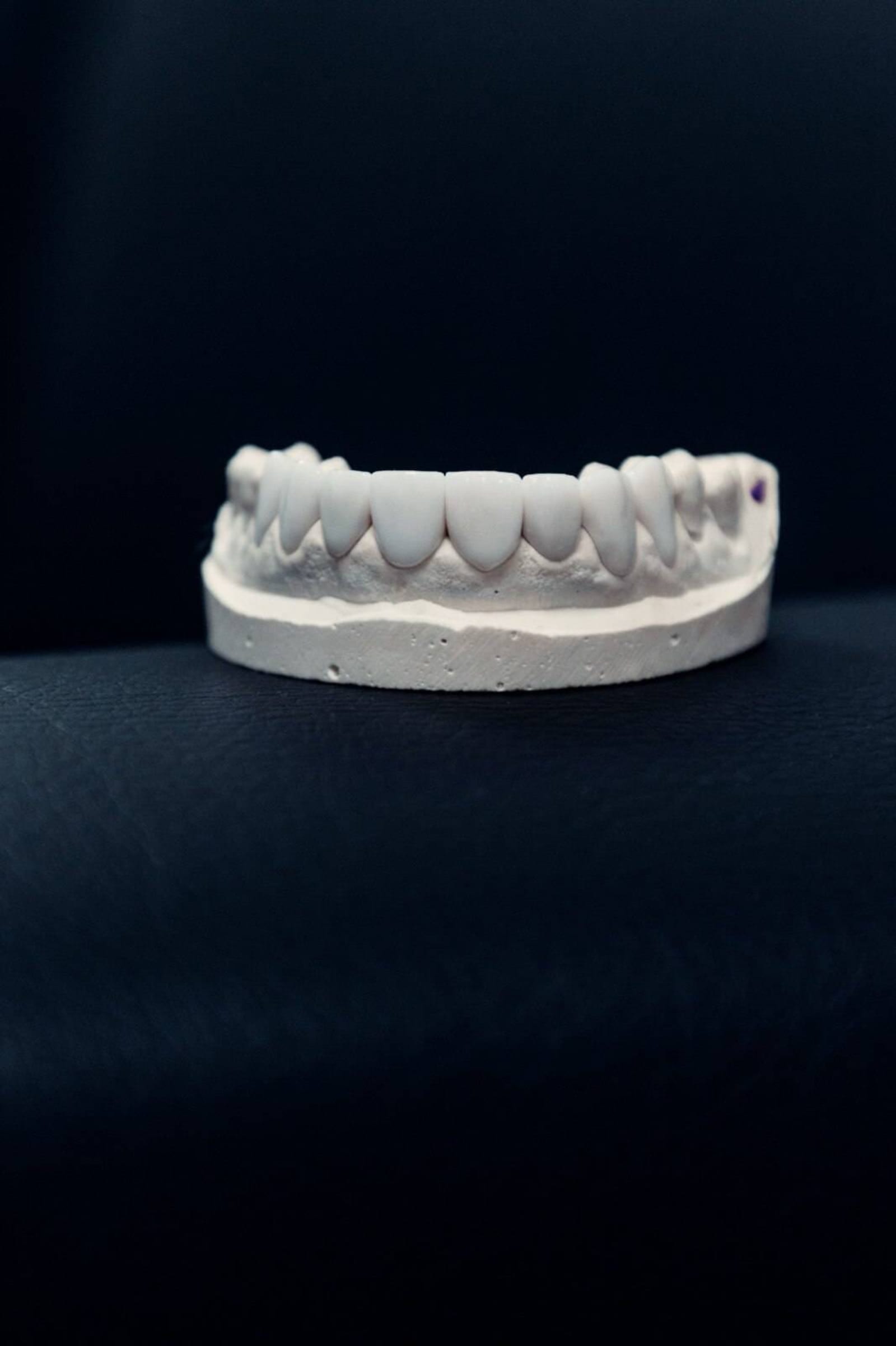 Porcelain veneer preparation and enamel reduction, Colombia Care Dental, Medellín