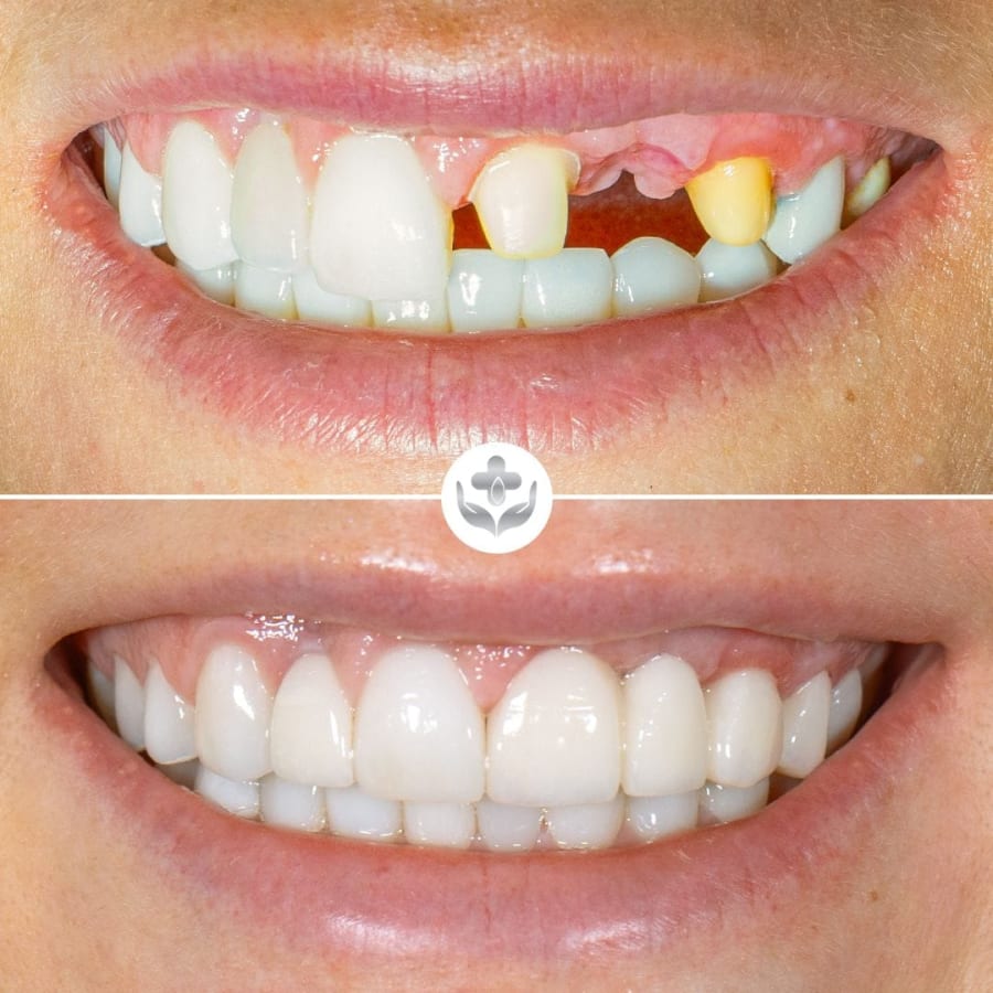 Before and after: an upper arch with missing and discoloured teeth rebuilt into a full, even row of ceramic restorations at Colombia Care Dental, Medellín