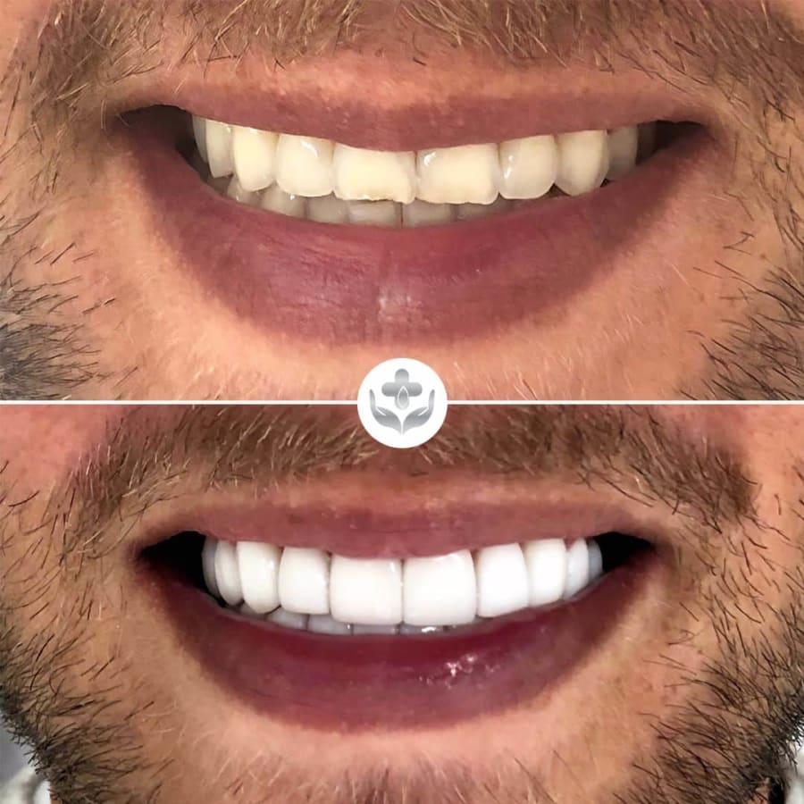 Before and after smile with porcelain veneers, Colombia Care Dental, Medellín