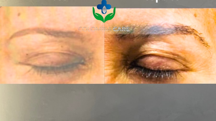 Trasplante de cejas antes y después, forma de la ceja restaurada — Colombia Care, Medellín