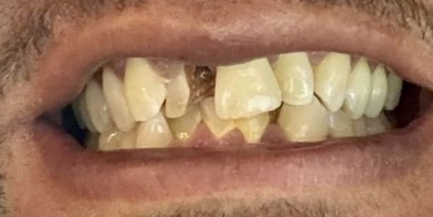 Antes, dientes frontales manchados, astillados y disparejos, Colombia Care Dental, Medellín
