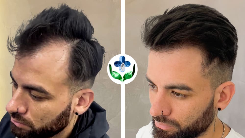 Antes y después de trasplante capilar FUE, línea frontal y entradas, paciente del grupo